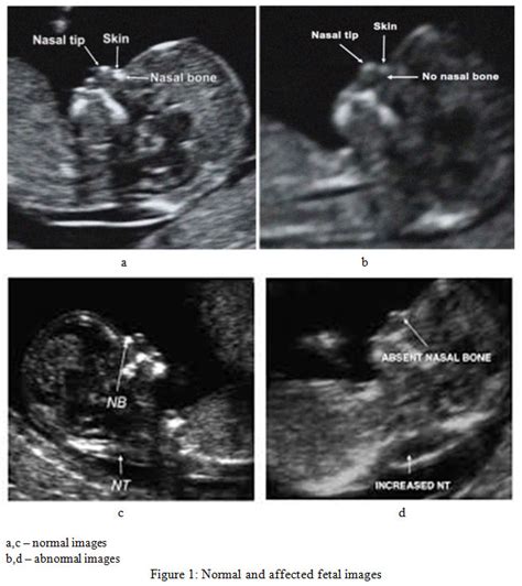 A soft marker is a fetal sonographic finding that is not an abnormality of development and generally has no negative impact on the babys health. . Soft markers for down syndrome on ultrasound